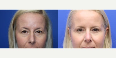 before and after image