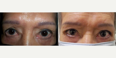 Canthoplasty before and after photo