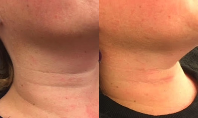 Dermal Fillers before and after photo