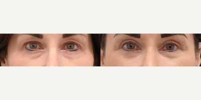 Eyelid Surgery before and after photo