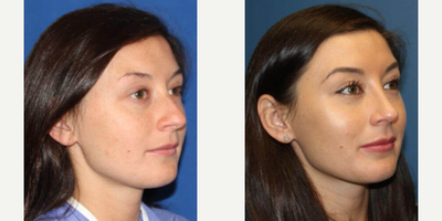 Septoplasty before and after photo