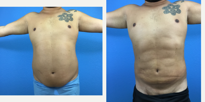 Vaser Liposuction before and after photo
