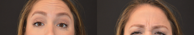 Botox before and after photo