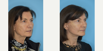 Mini Neck Lift before and after photo