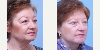 Deep Plane Facelift before and after photo