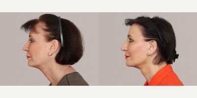 Mini Facelift before and after photo