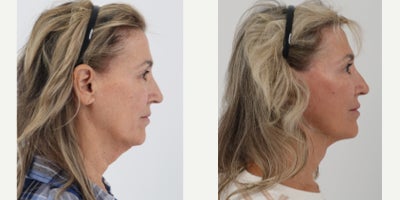 Neck Lift before and after photo