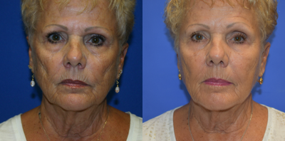 Bellafill before and after photo