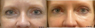 Belotero before and after photo