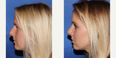 Rhinoplasty before and after photo