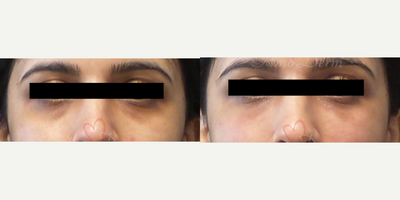 Dermal Fillers before and after photo