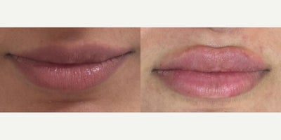 Dermal Fillers before and after photo