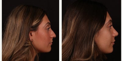 Rhinoplasty before and after photo