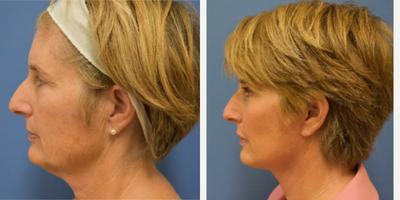 Facelift before and after photo