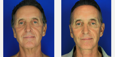 Facelift before and after photo