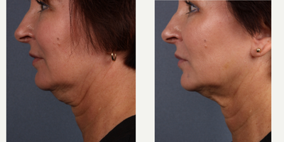 Kybella before and after photo