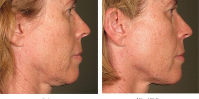 Ultherapy before and after photo