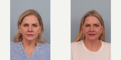Facelift before and after photo