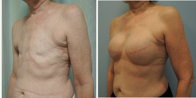 Breast Reconstruction before and after photo