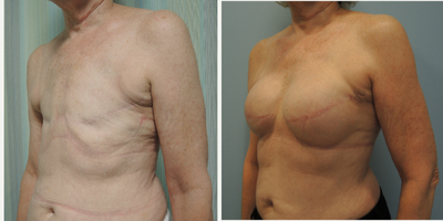 Breast Reconstruction before and after photo