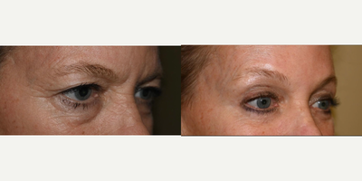 Brow Lift before and after photo