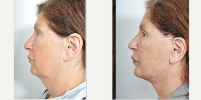 Facelift before and after photo