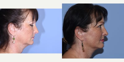 Facial Fat Transfer before and after photo