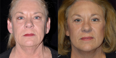 Brow Lift before and after photo