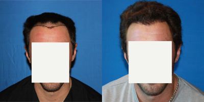 Hair Transplant before and after photo