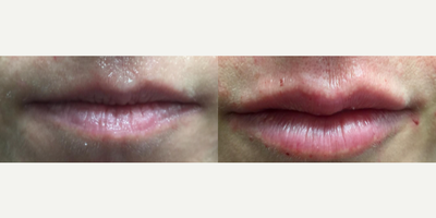 Lip Fillers before and after photo