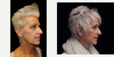 Mini Facelift before and after photo