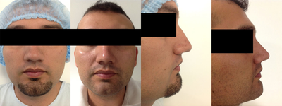 Rhinoplasty before and after photo