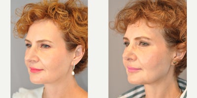 Rhinoplasty before and after photo