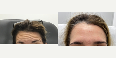 Botox before and after photo