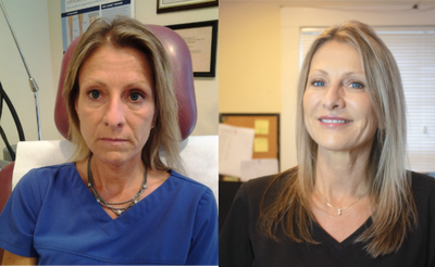 Bellafill before and after photo