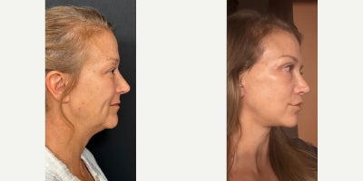 Deep Plane Facelift before and after photo