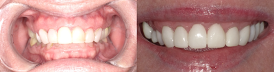 Dental Crown before and after photo