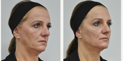 Dermal Fillers before and after photo