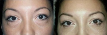 Eyelid Surgery before and after photo