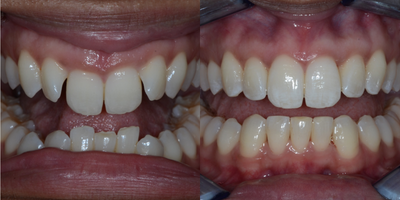 Invisalign before and after photo
