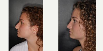 Septoplasty before and after photo