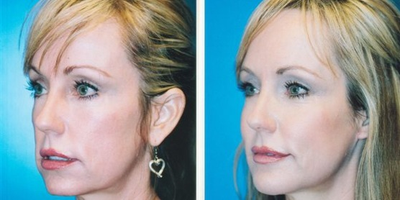 Cheek Augmentation before and after photo