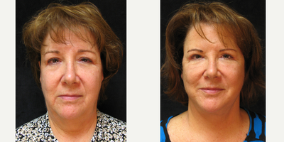 Facelift before and after photo