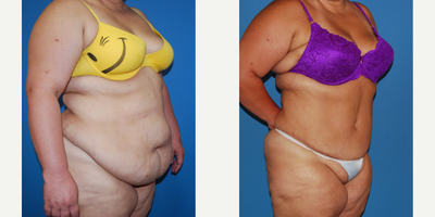 Panniculectomy before and after photo