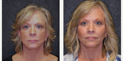 Chin Implant before and after photo