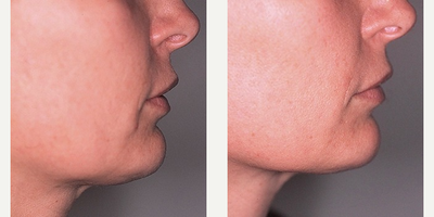FaceTite before and after photo