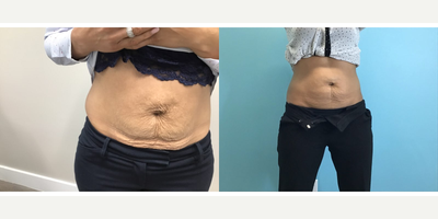 Skin Tightening before and after photo