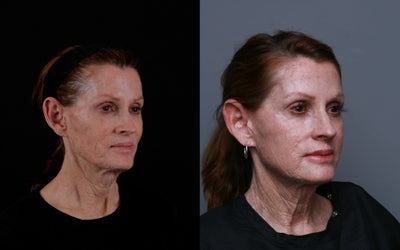 Voluma before and after photo