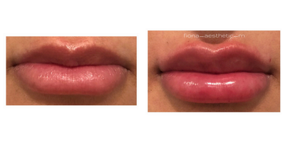 Dermal Fillers before and after photo