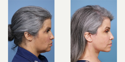 Eyelid Surgery before and after photo